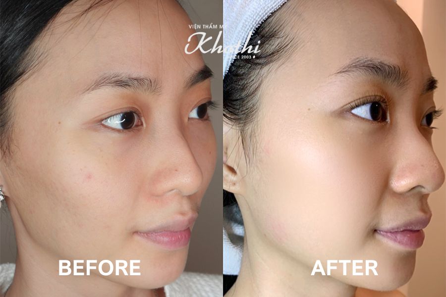 Siêu tinh chất Shimmer4