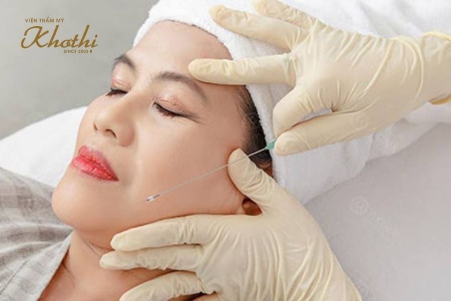 Căng chỉ collagen