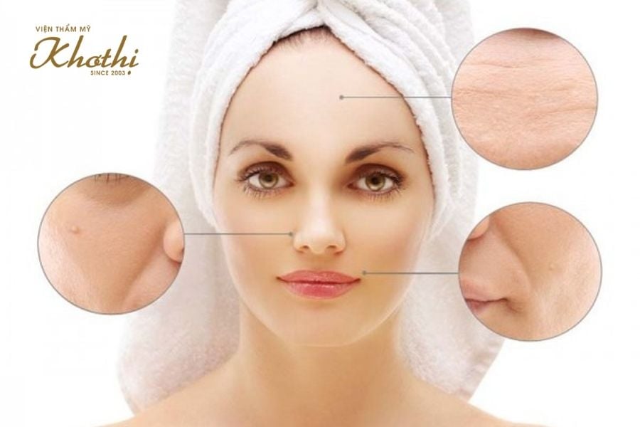 Căng chỉ collagen