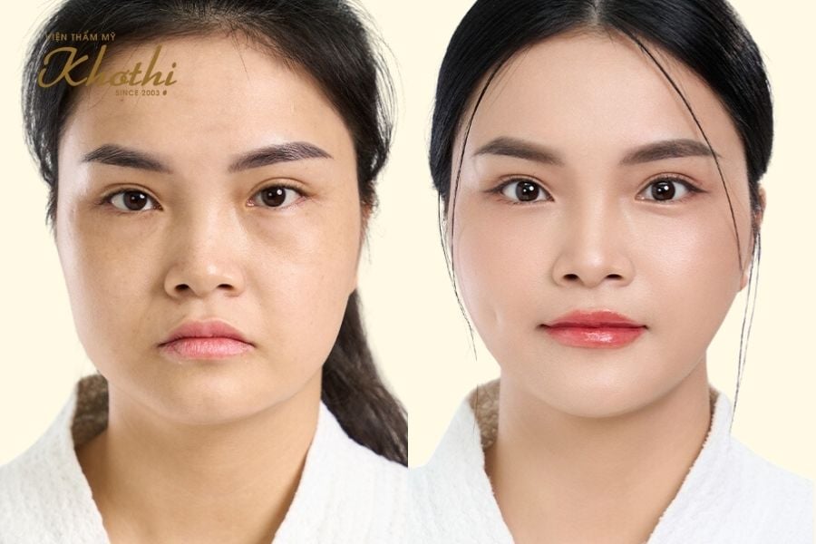 Căng chỉ Khơ Thị