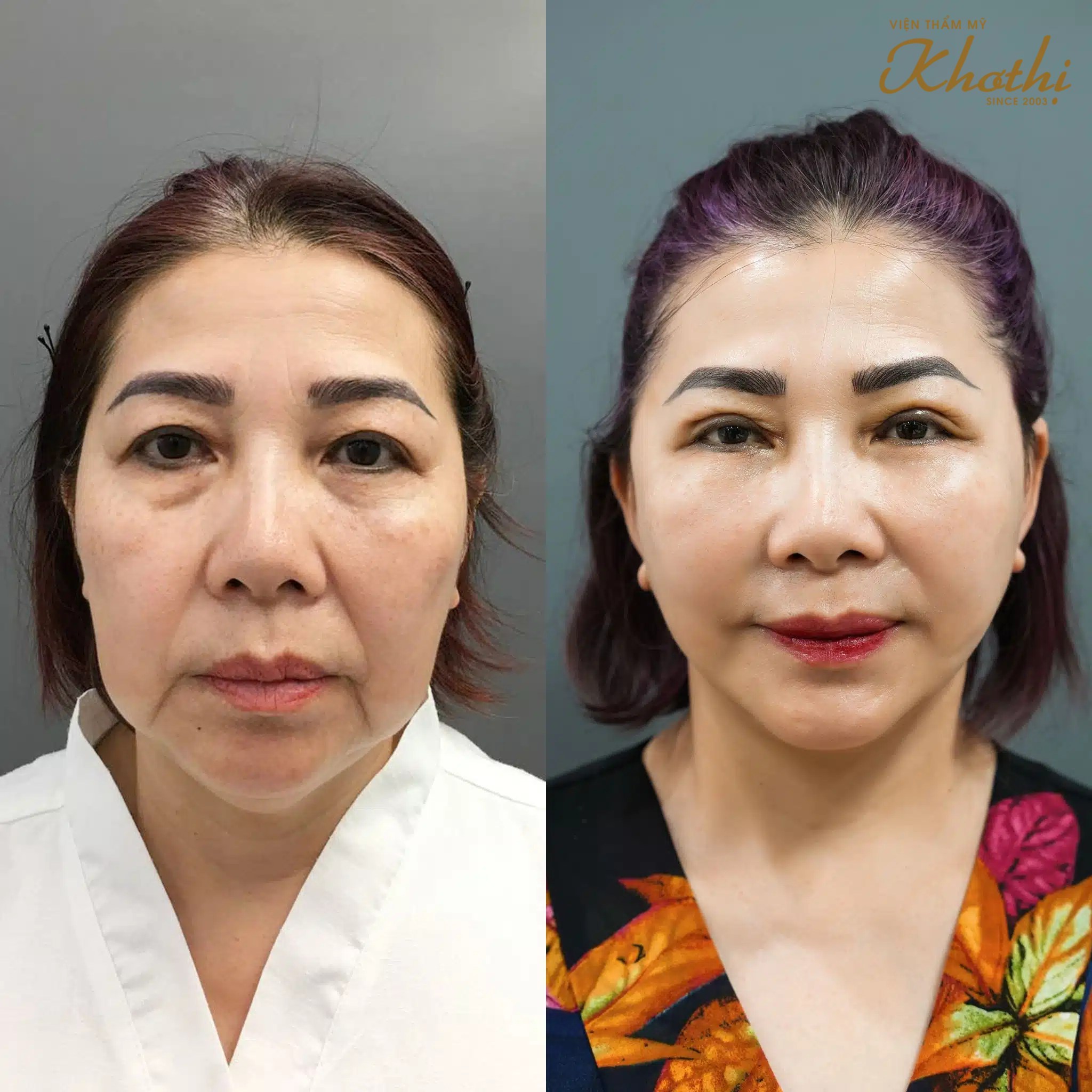 căng chỉ da mặt