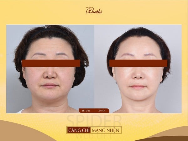 cơ mặt nâng lên sau khi căng chỉ mạng nhện