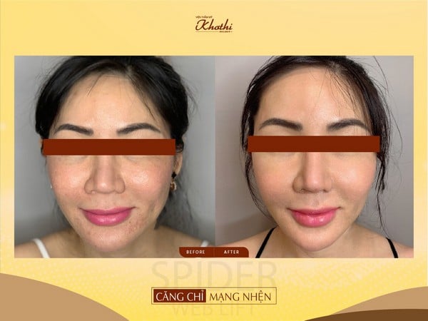 trước và sau khi căng chỉ mạng nhện