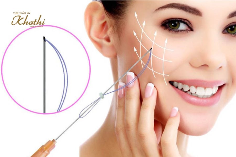 Cấy chỉ trẻ hóa da
