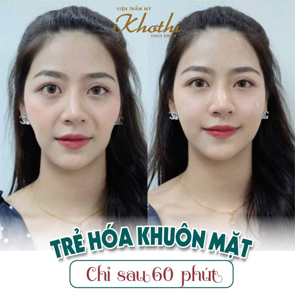 căng chỉ rãnh cười 