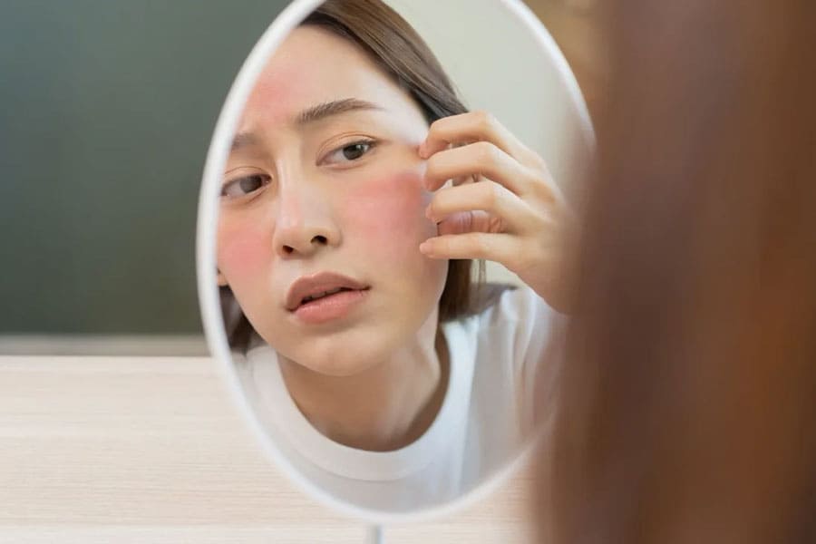 Căng da bằng chỉ Khơ Thị