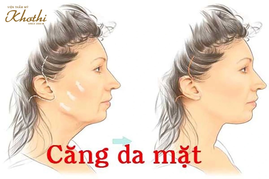 Căng da mặt