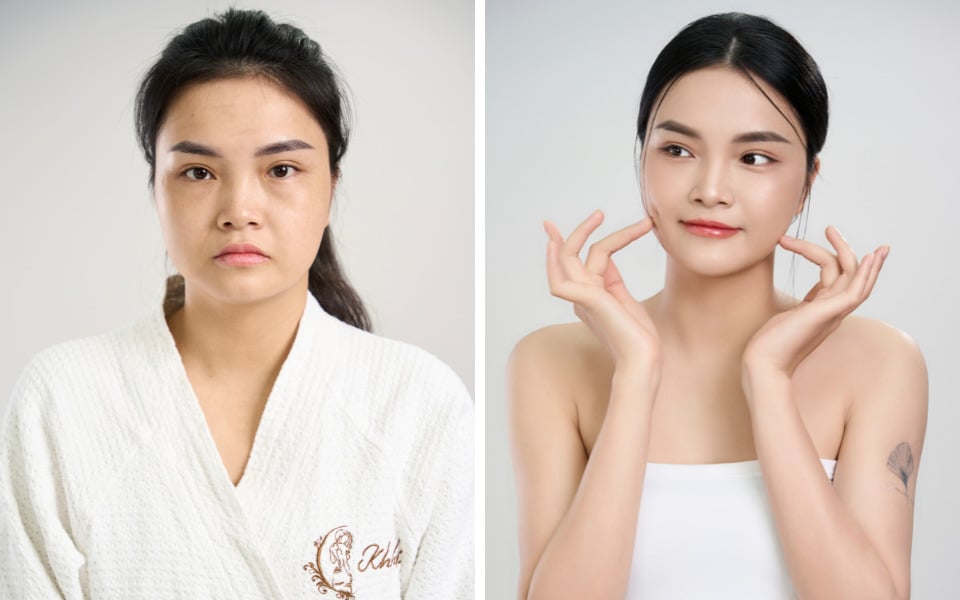 cấy chỉ collagen