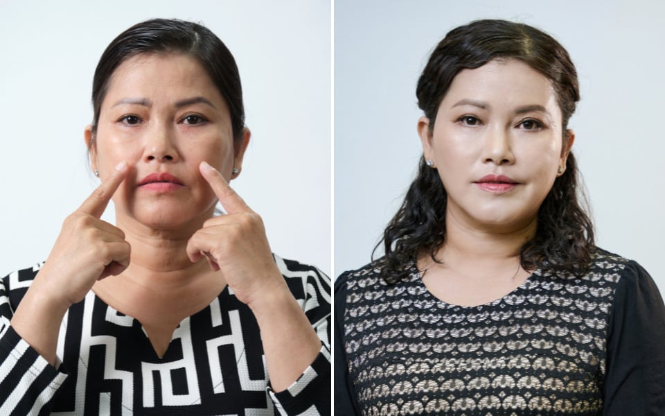 căng chỉ collagen