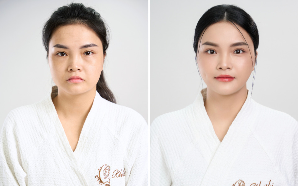 căng chỉ collagen có đau không