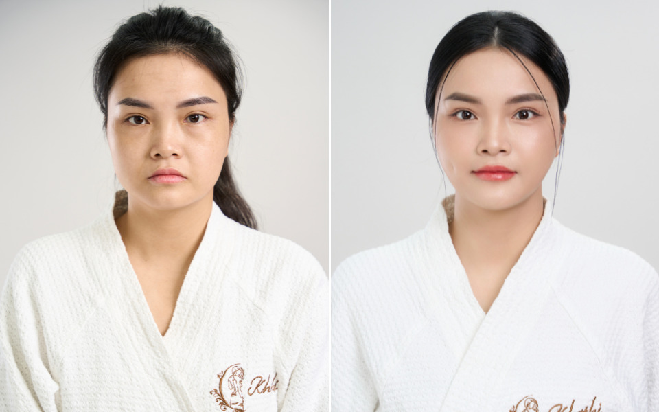 căng chỉ khơ thị