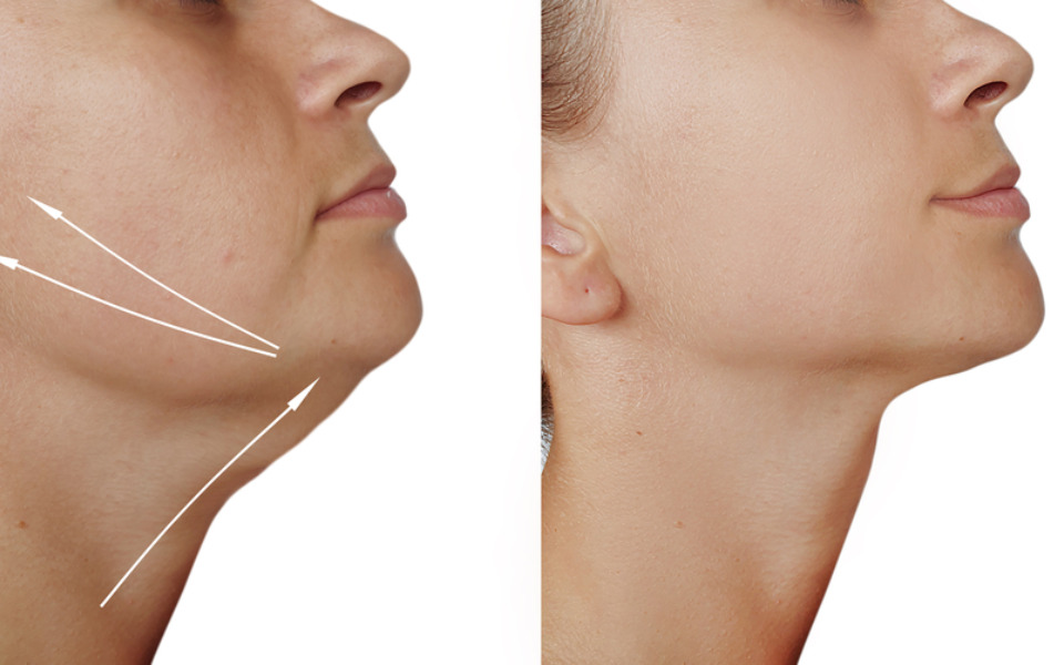 căng da với elastin matrix 8d