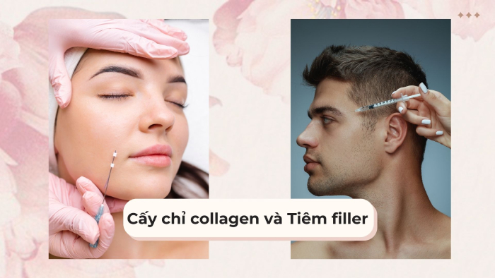 So sánh cấy chỉ collagen và Tiêm filler