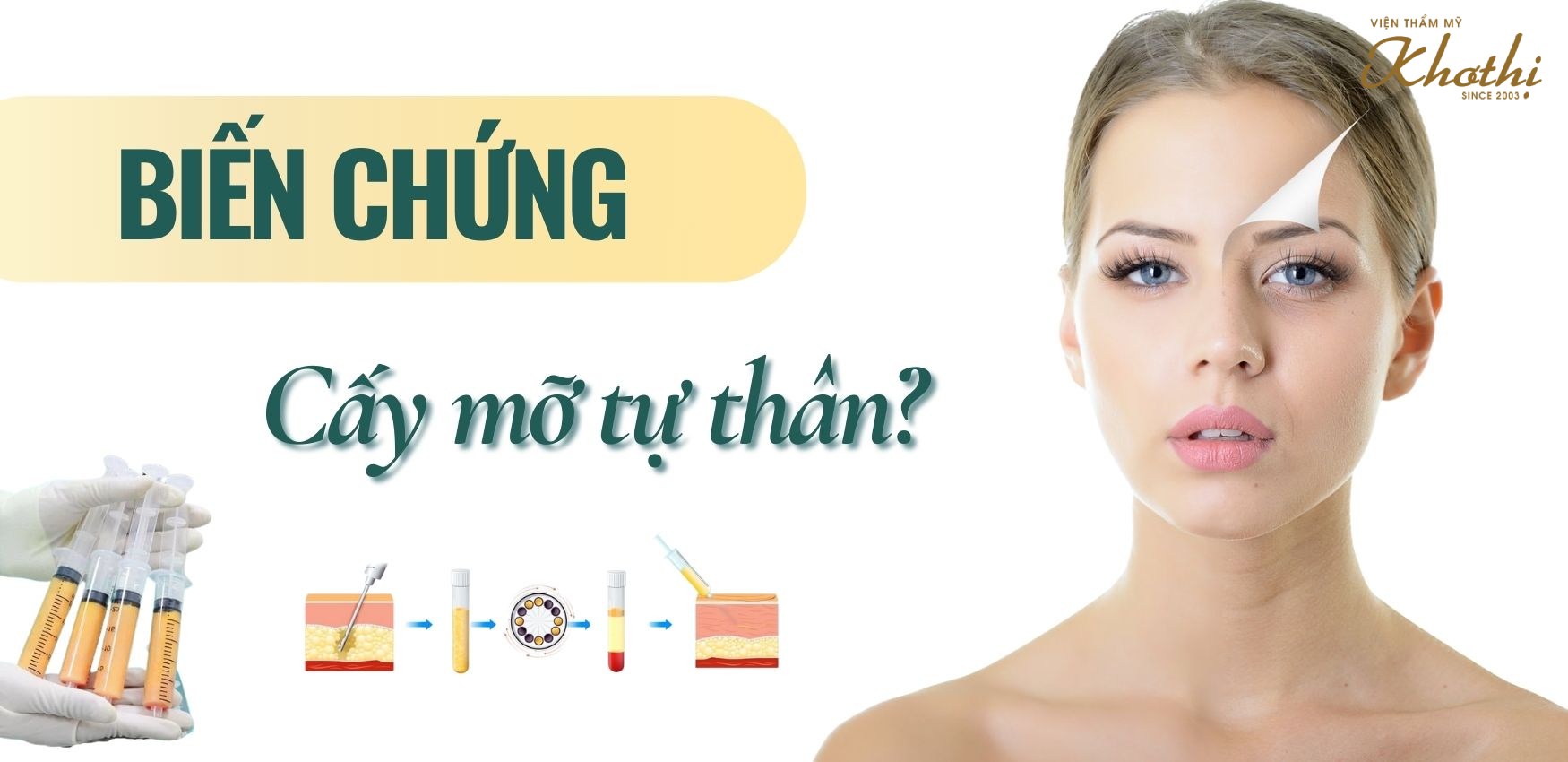cấy mỡ mặt