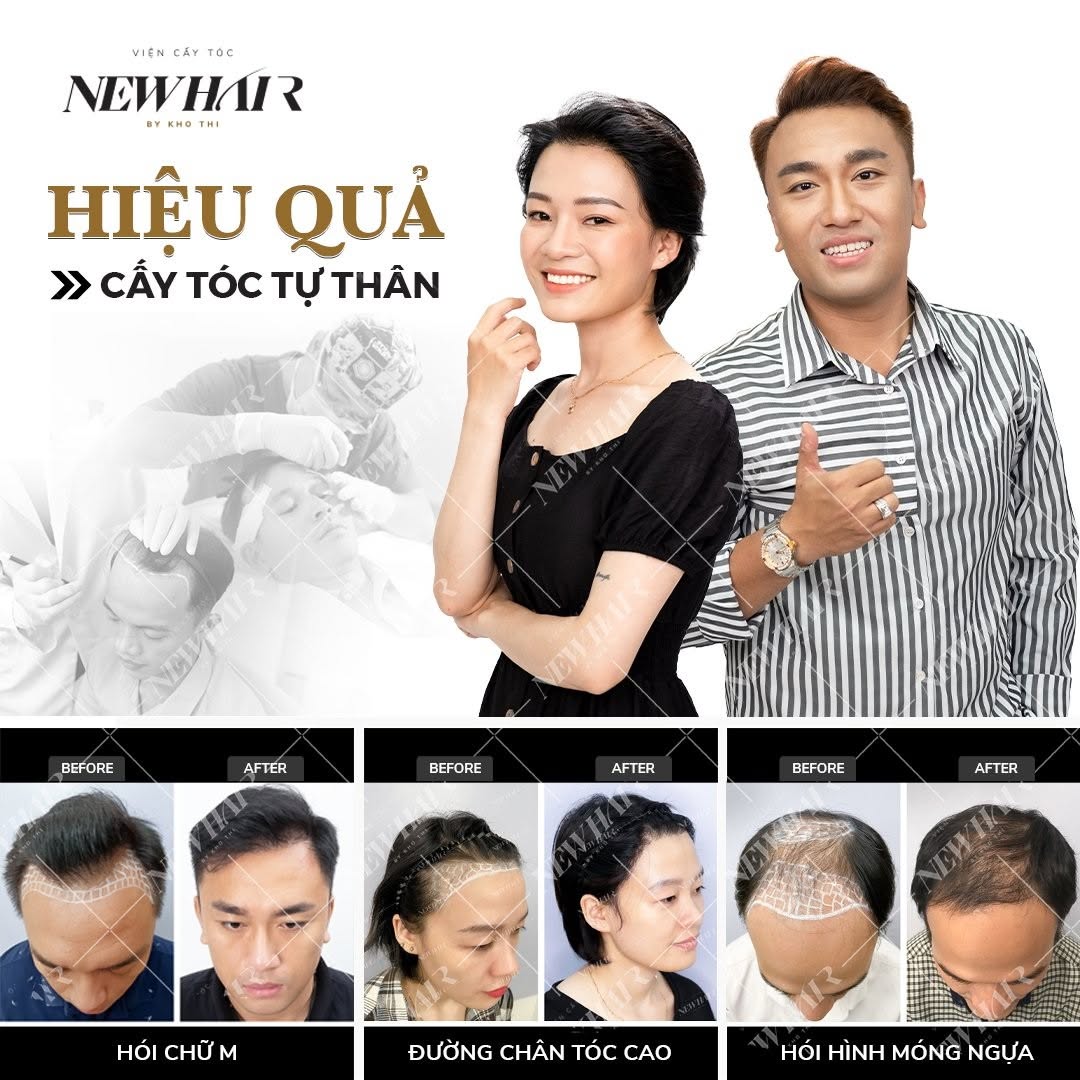 cấy tóc tự thân newhair by khơ thị