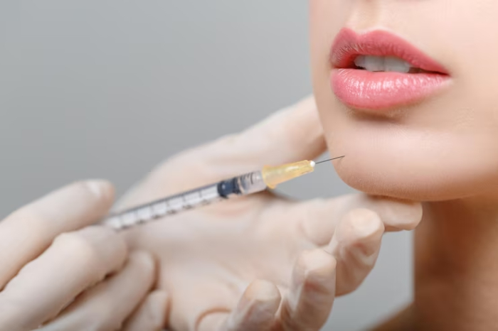 Chất lượng filler có mối quan hệ mật thiết với thời gian duy trì hiệu quả làm đẹp.