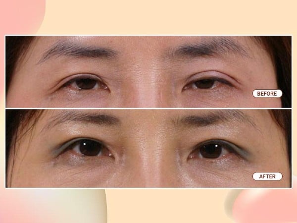 Khắc phục các lỗi thẩm mỹ, chỉnh hình sau cắt mí cho đôi mắt đẹp tự nhiên Khắc phục các lỗi thẩm mỹ, chỉnh hình sau cắt mí cho đôi mắt đẹp tự nhiên