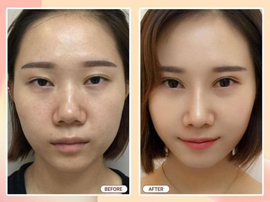 Khắc phục biến chứng sau sửa mũi tại Khơ Thị Khắc phục biến chứng sau sửa mũi tại Khơ Thị