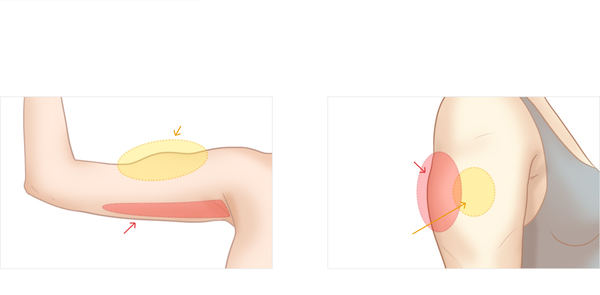 Cơ thế giảm mỡ tiêm Filler