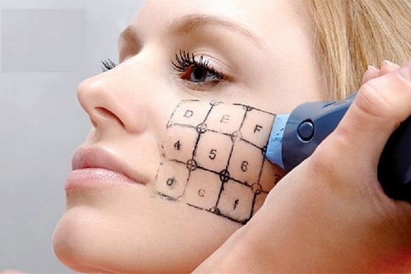 Người phụ nữ đang thực hiện nâng cơ bằng công nghệ trẻ hóa da Thermage