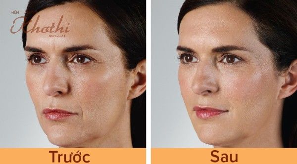 Làn da căng mịn, giảm rõ nếp nhăn ở mép sau tiêm trẻ hóa da bằng HA