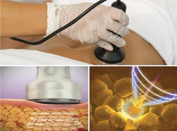 Công nghệ Cavi Lipo