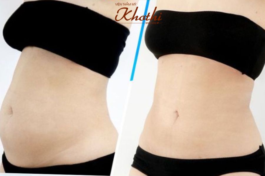 Công nghệ Miko Diet Khơ Thị