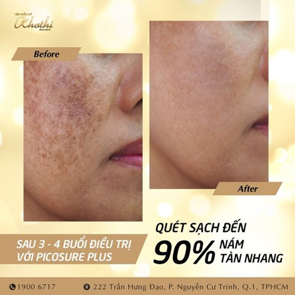 Công nghệ Picosure Plus không xâm lấn