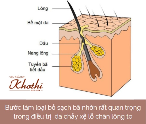 Cổ nang lông bít tắc bụi bẩn, bã nhờn lâu ngày sẽ làm lỗ chân lông to.