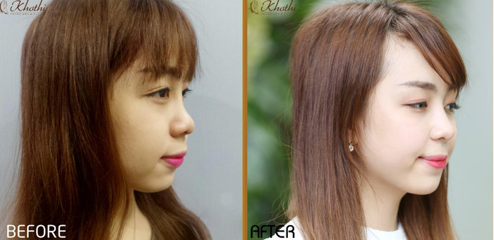 Bạn nên tiêm filler mũi để sở hữu dáng mũi cao, thanh thoát mà không cần phẫu thuật