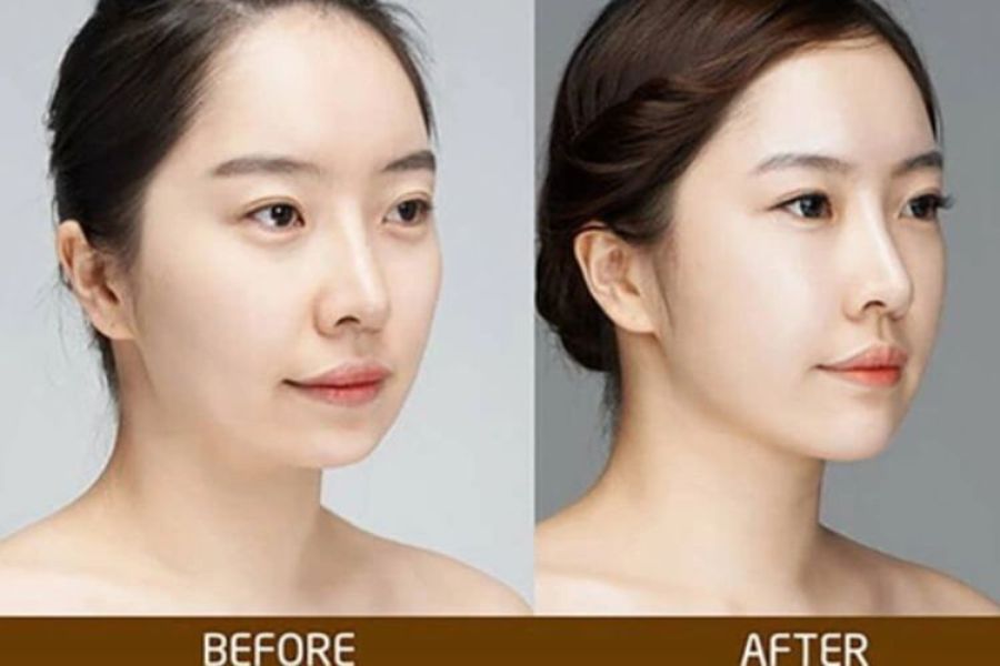 Độn cằm thon gọn gương mặt trở nên xinh đẹp, thanh thoát hơn