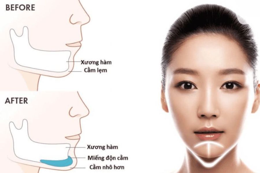 dịch vụ độn cằm khơ thị