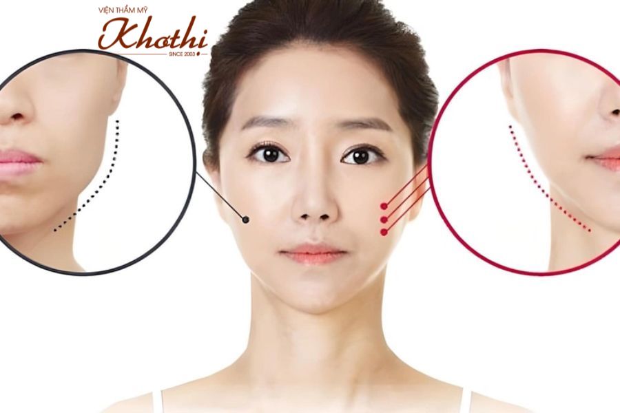 Tiêm botox giúp thon gọn hàm