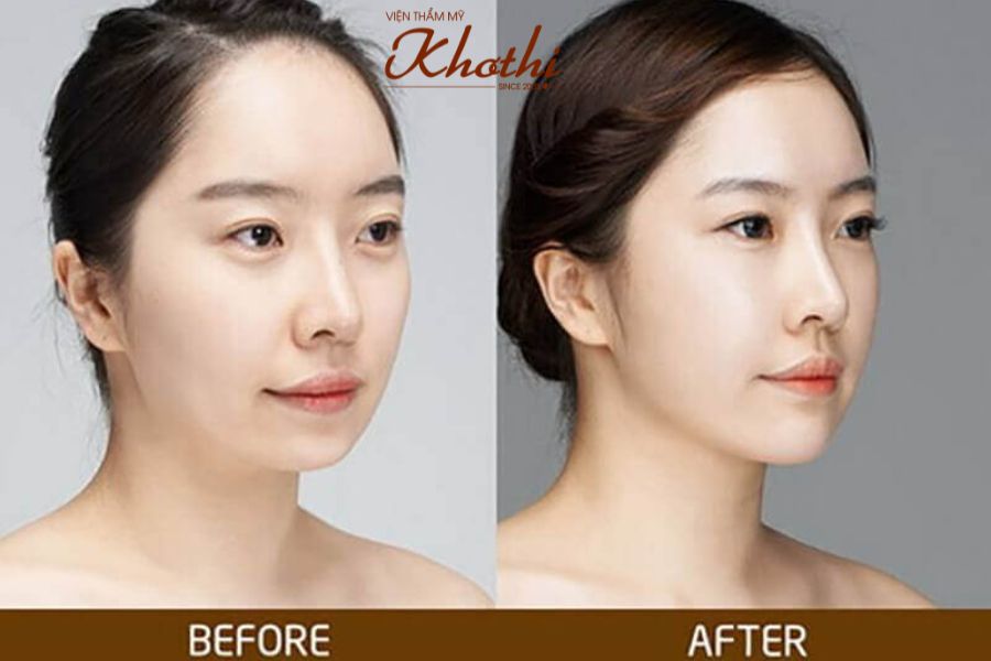 Tiêm filler để cứu cánh chiếc cằm lẹm