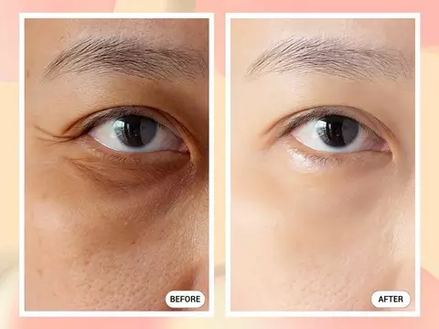 Sử dụng công nghệ Ultherapy vùng mắt và Ulthera Ionic để điều trị nếp nhăn nơi khóe mắt nhanh chóng và hiệu quả hơn.