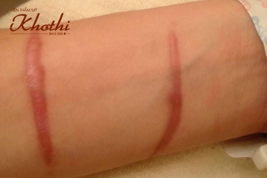 Điều trị sẹo Khơ Thị
