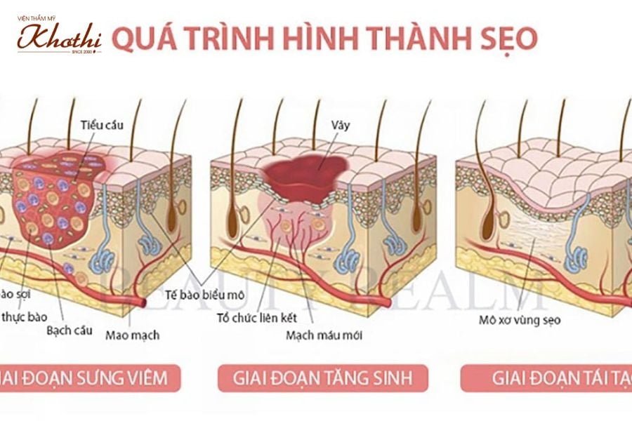Quá trình hình thành sẹo