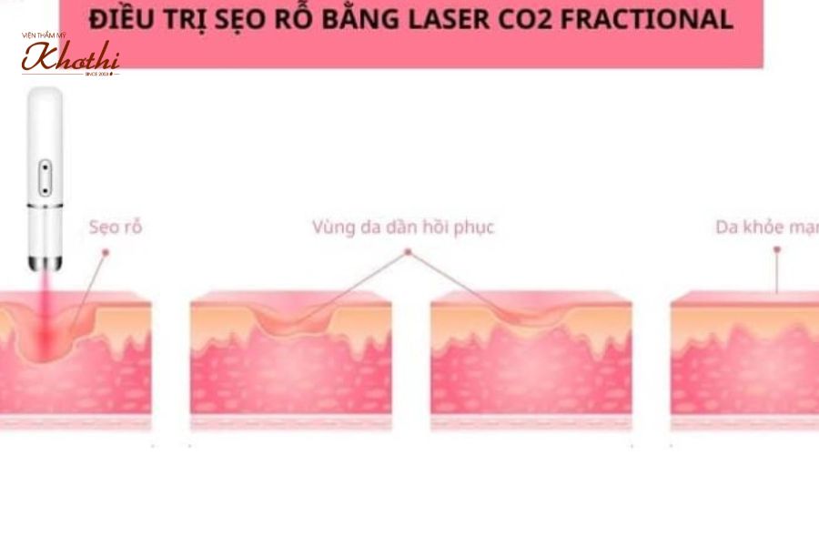 Quy trình điều trị sẹo Khơ Thị đúng chuẩn y khoa