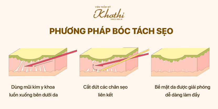 Phương pháp bóc tách đáy trị sẹo rỗ, lõm
