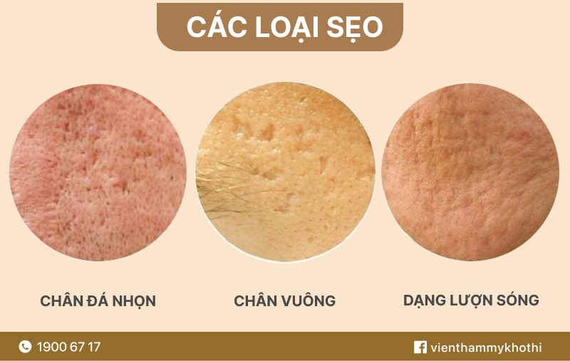 Các loại sẹo trên bề mặt da