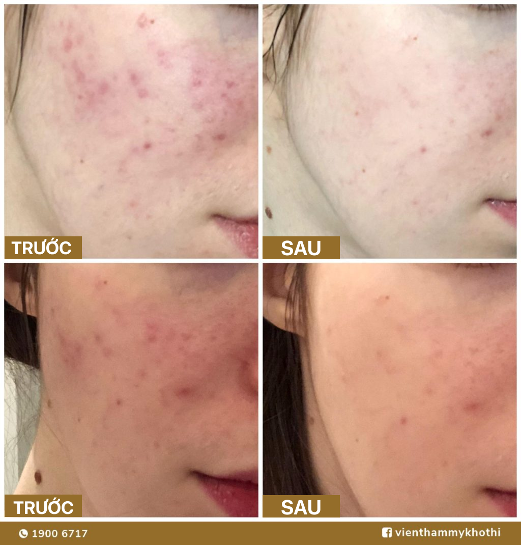 Tại sao nên điều trị thâm mụn Khơ Thị