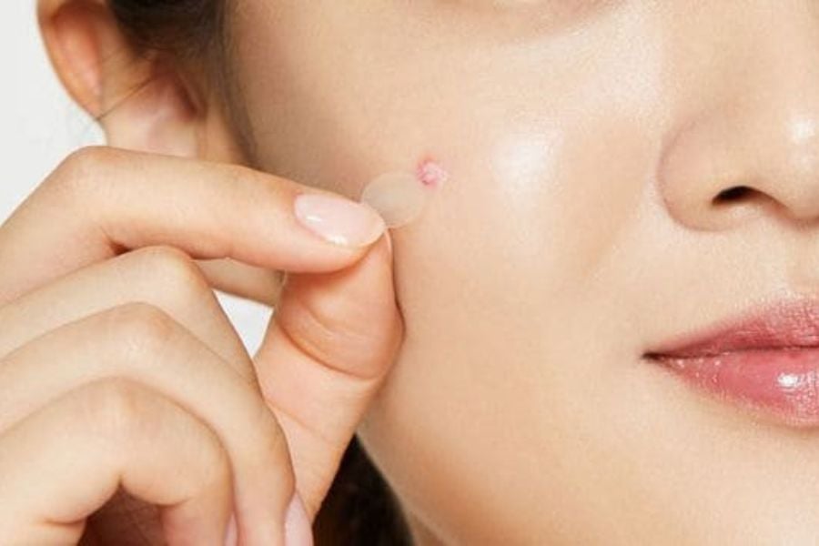 Điều trị mụn Khơ Thị top 1