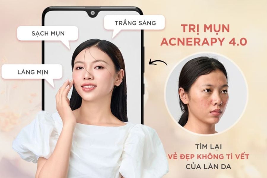 Điều trị mụn Khơ Thị top 1