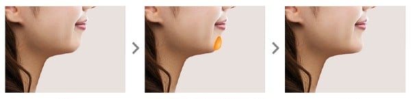 Tùy tình trạng gương mặt Bác sĩ sẽ lựa chọn miếng độn có kích thước phù hợp