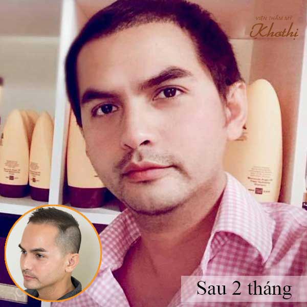 Đức tiến sau khi cấy tóc 2 tháng