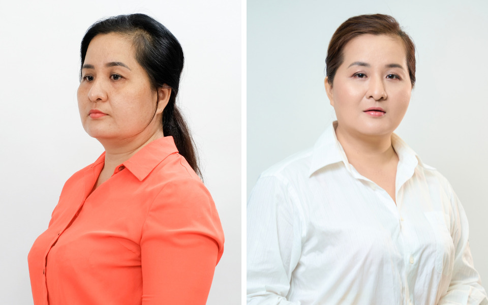 chọn elastin matrix 8d hay hifu