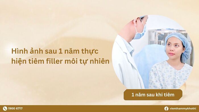 Filler bắt đầu tan rã sau khoảng 1 năm thực hiện filler