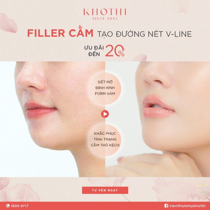 Cải thiện diện mạo với tiêm filler cằm.