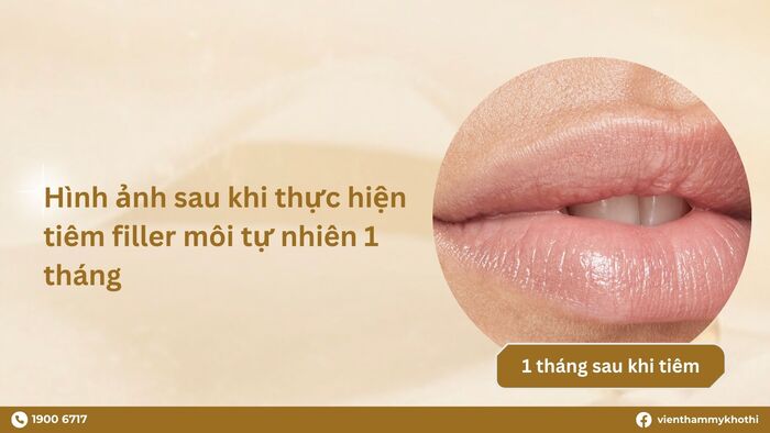 Filler sẽ hoàn toàn ổn định sau 1 tháng thực hiện tiêm filler môi tự nhiên