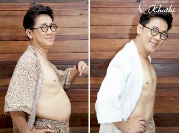 Tạm biệt bụng bia nhanh chóng với MIKO DIET